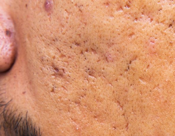 Acne pits