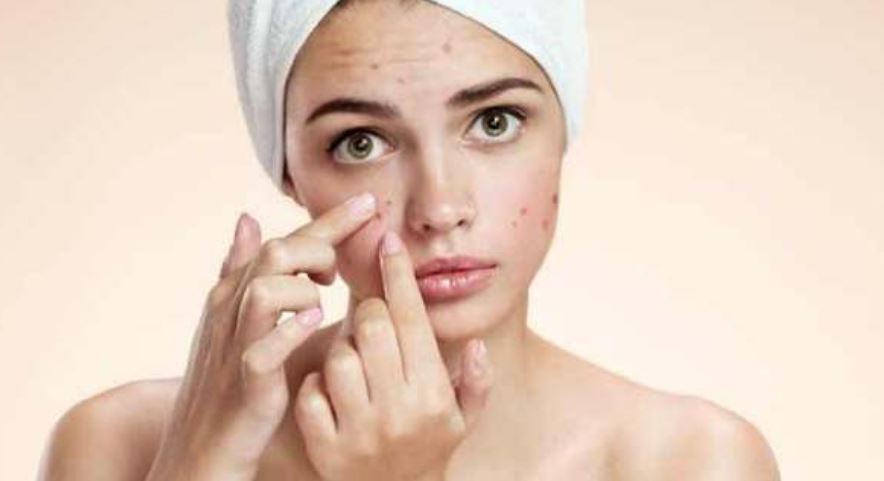 Acne prone skin