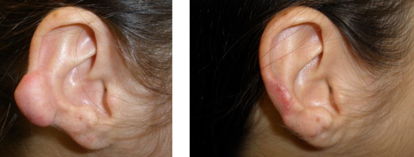 Before and after ear keloid remova - Courtesy of Dermatology Institute of Southern California