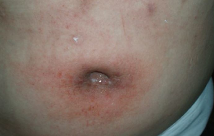 Belly button discharge causes - white