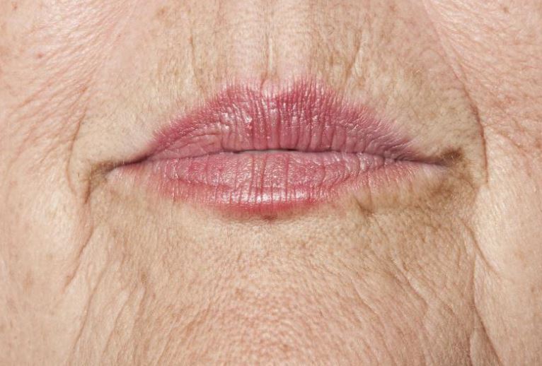 Causes of wrinkled lips and how to manage them