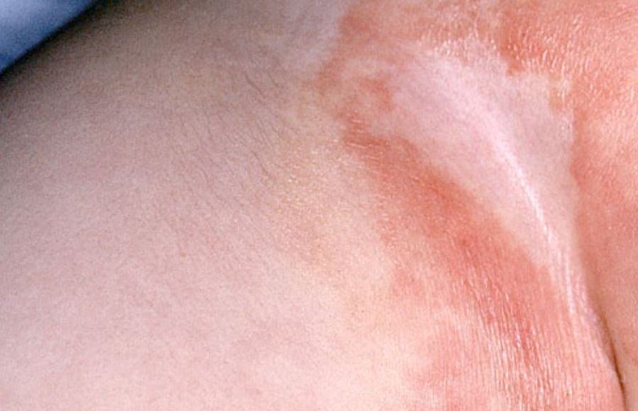 Chafed groin area and creases