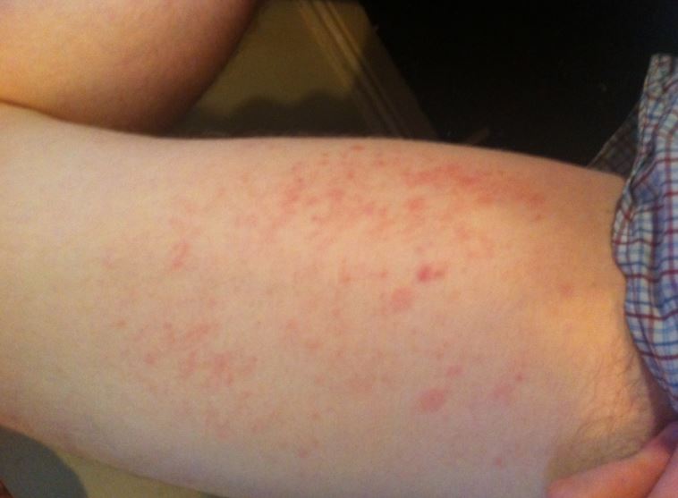 Chafed thighs causes and how to get rid