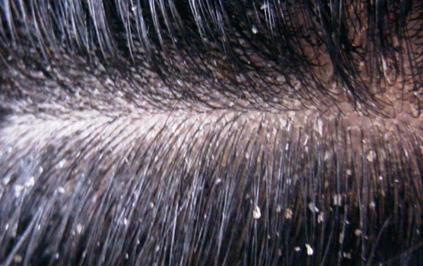 Dandruff
