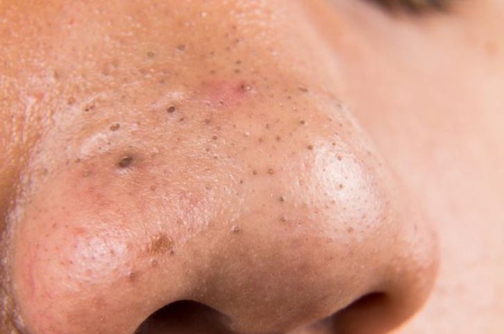 Dark blackheads spots on nose