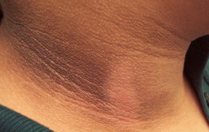Dark neck or dark spots on neck