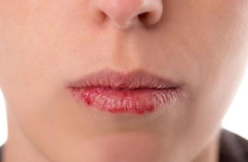 Dry peeling lips during pregnancy