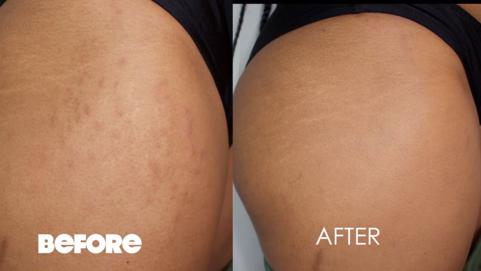 How to hide stretch marks