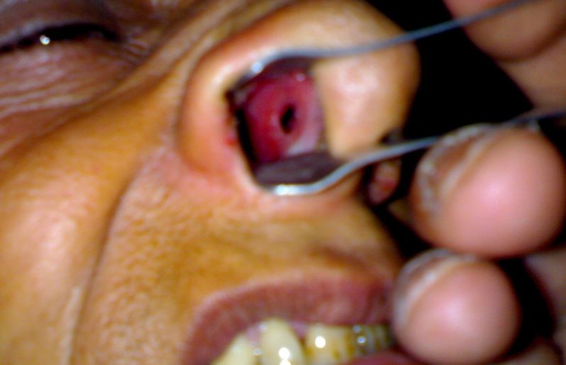 Nasal septum perforations