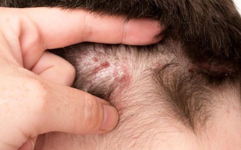 Psoriasis can be one of the causes of an irritated scalp
