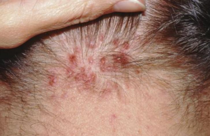 Red bumps on scalp causes