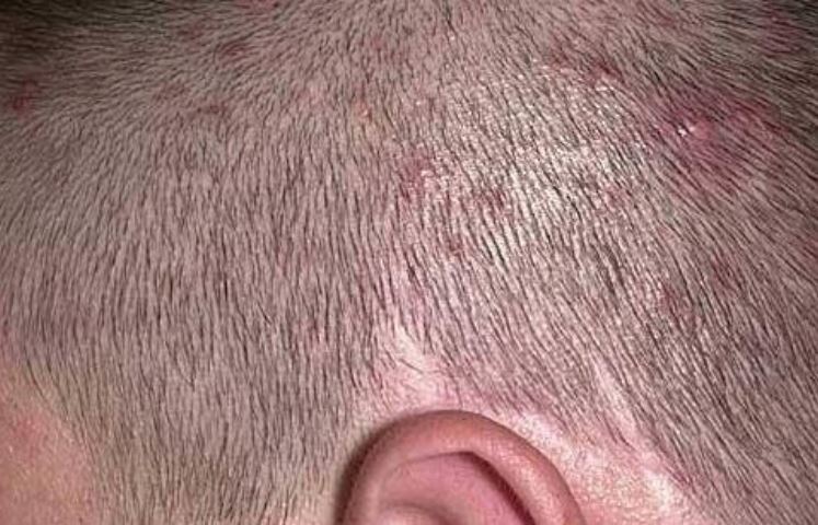 Scalp folliculitis picture
