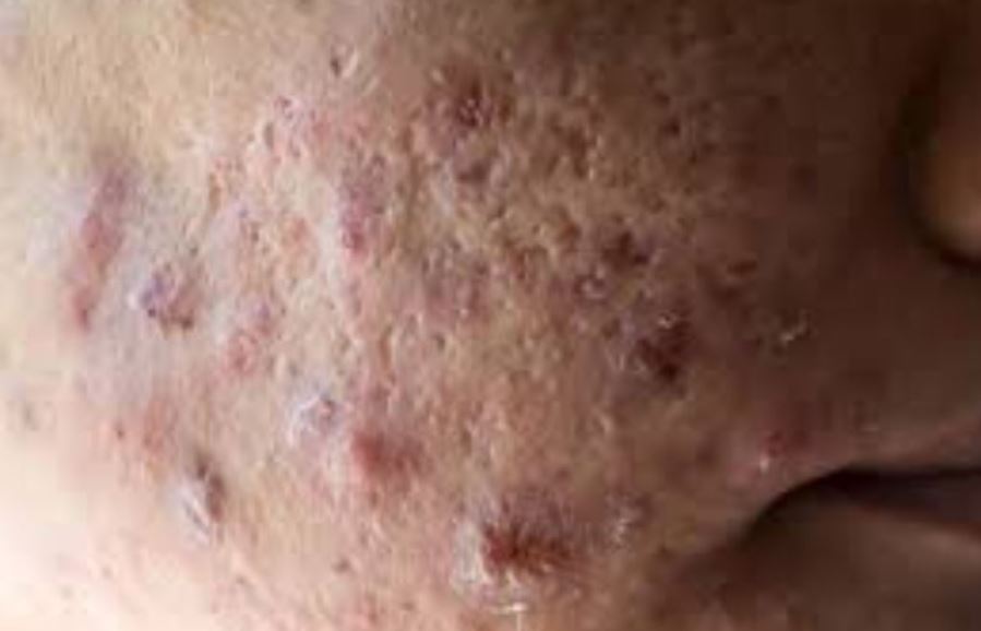 Severe pimple scabs on face or cheeks