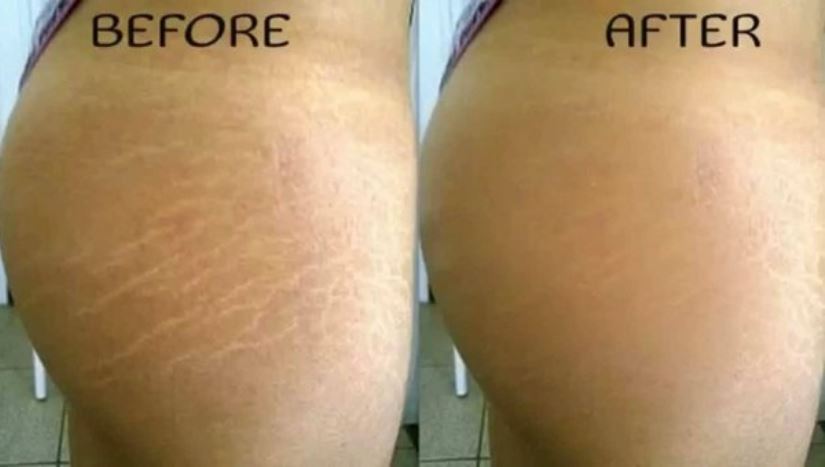 Stretch marks on buttocks before and after treatment by laser