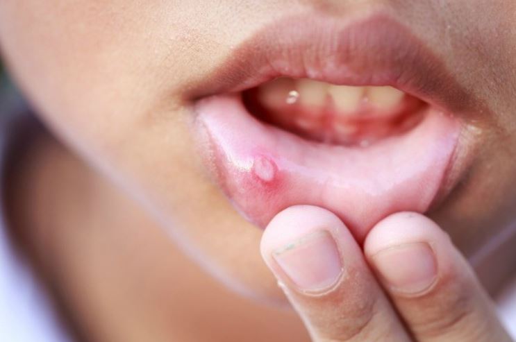 Blisters inside of lips - on lower inner lip