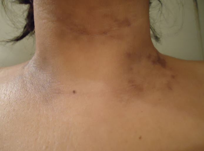 Brown spots on neck causes