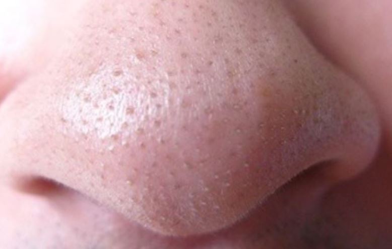 Clogged nose pores - whiteheads or blackheads causes