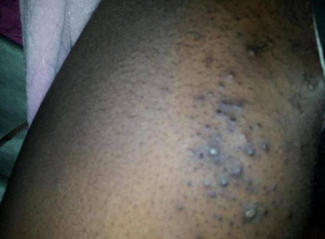 Dark bumps on inner thighs