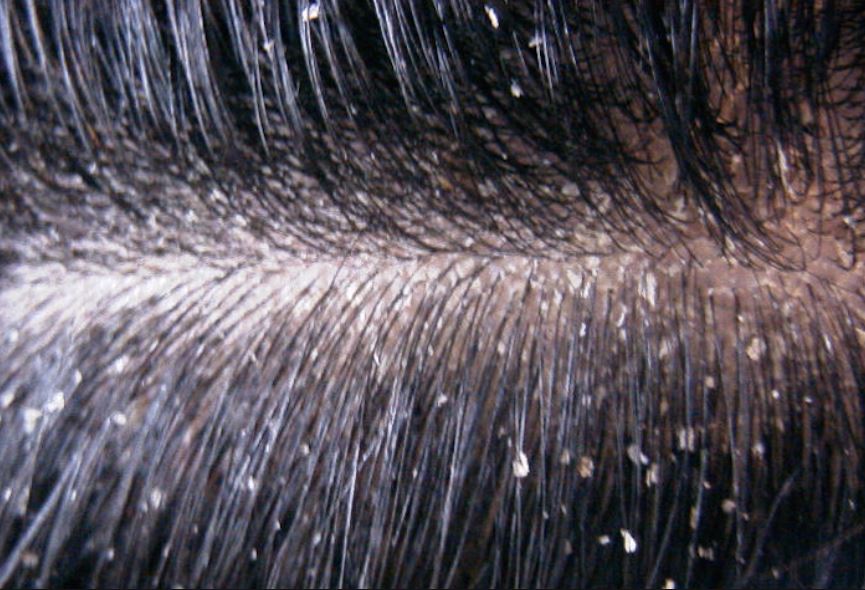 Dry flaky scalp