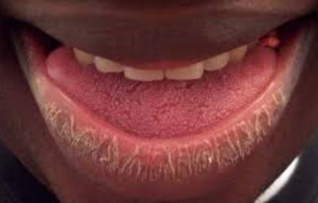 Extremely dry flaky lips