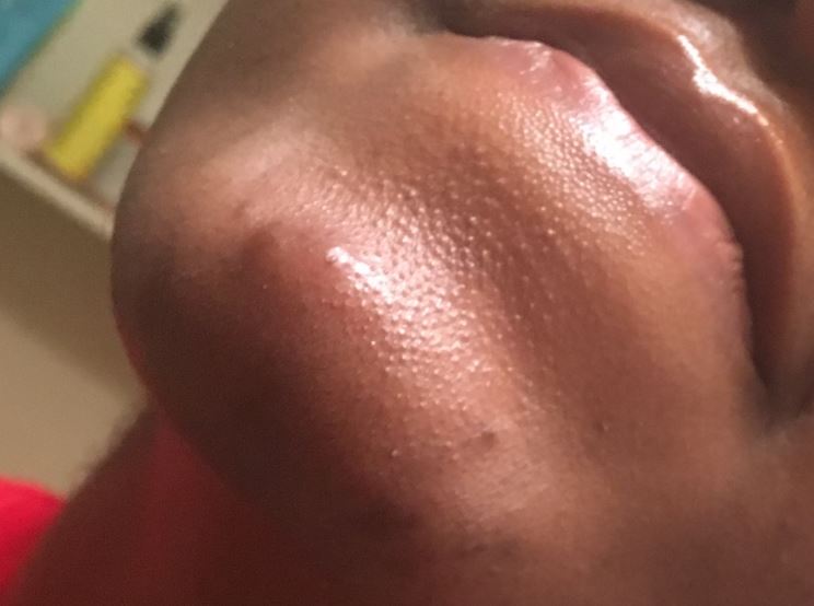 How do you get rid of clogged pores on your chin.