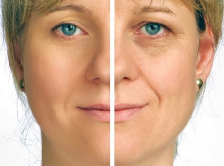 How to get rid of laugh lines