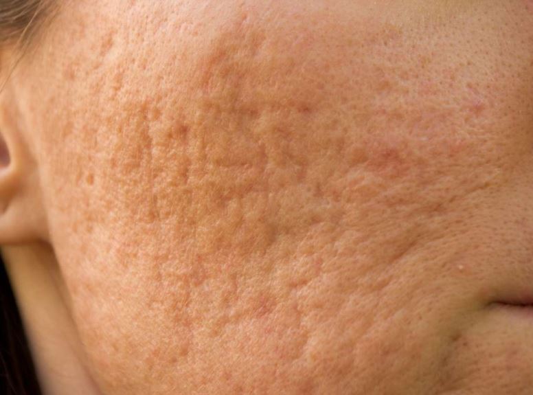 Indented skin or pockmarks