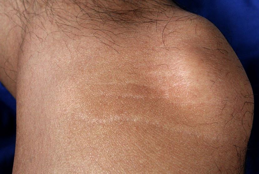 Knee stretch marks or striae