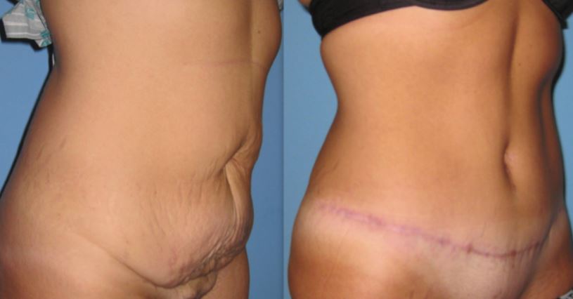 Loose skin surgery - Vennemeyer Plastic Surgery