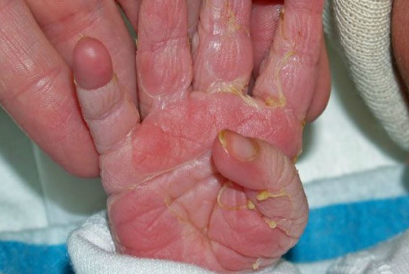 Newborn skin peeling on hand