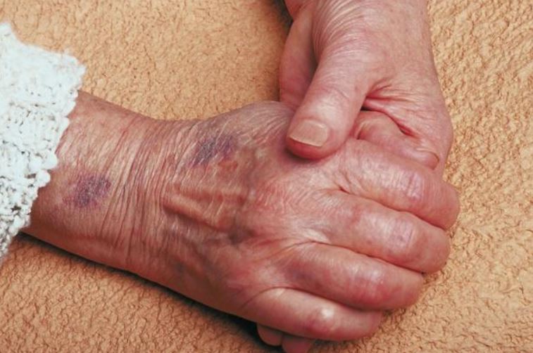 Purple skin discoloration