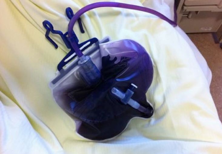 Purple urine syndrome