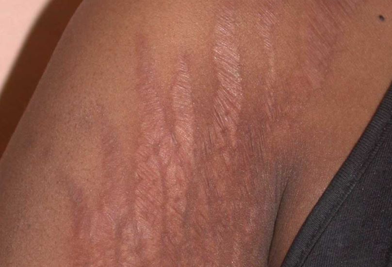 Stretch marks on arms causes and treatments