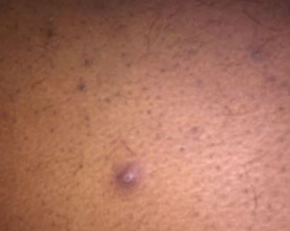 What causes pimples on my inner thighs