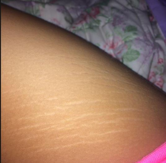 What causes stretch marks on thighs