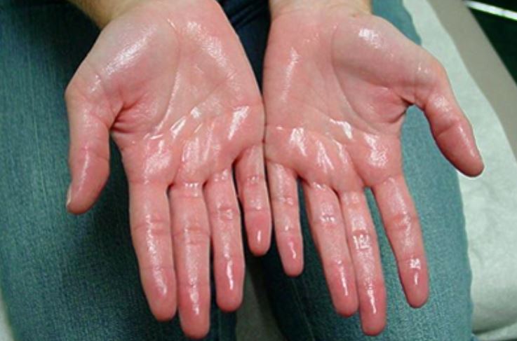 Why are my palms or hands so sweaty