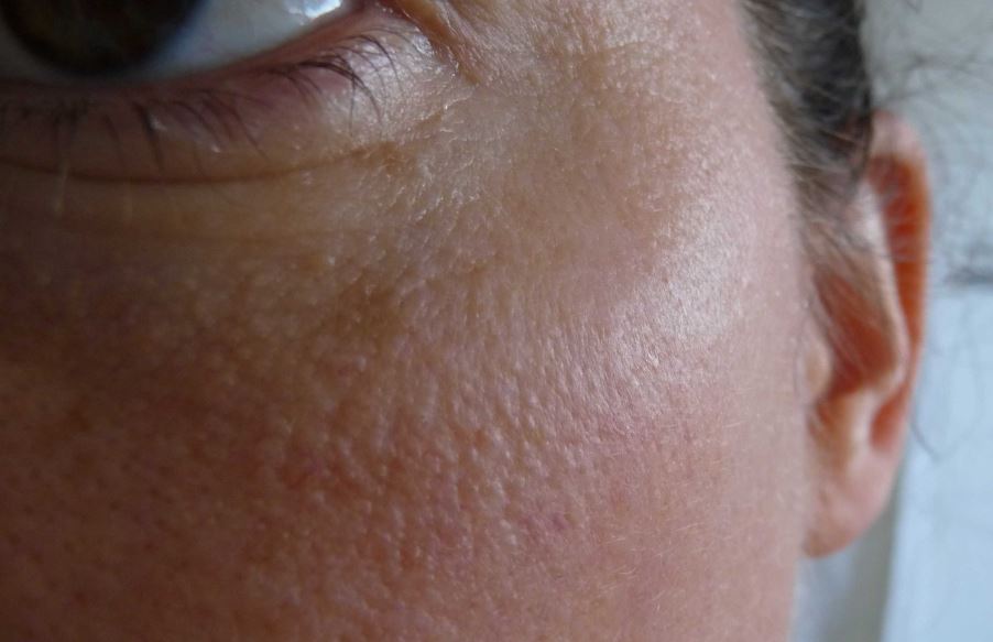 Why is the skin on my face bumpy