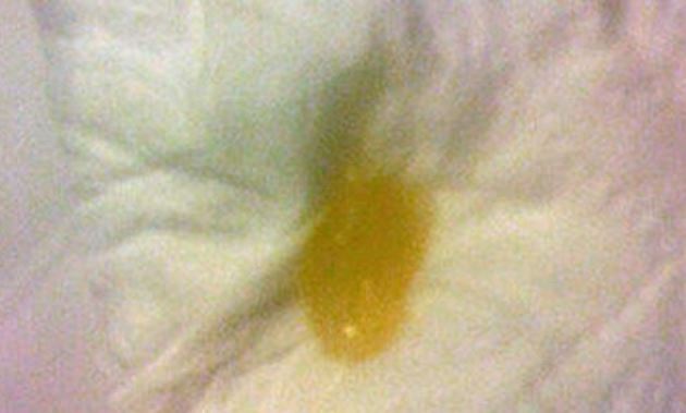 Yellow snot or mucus causes