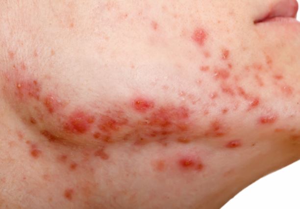 Acne on jawline, neck and chin