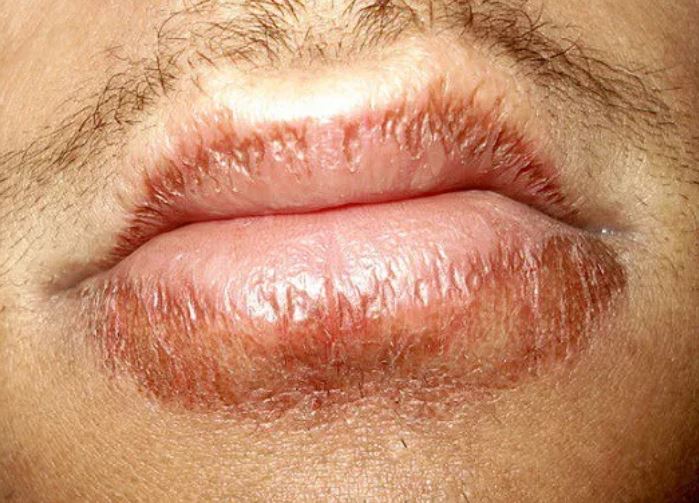 Cheilitis