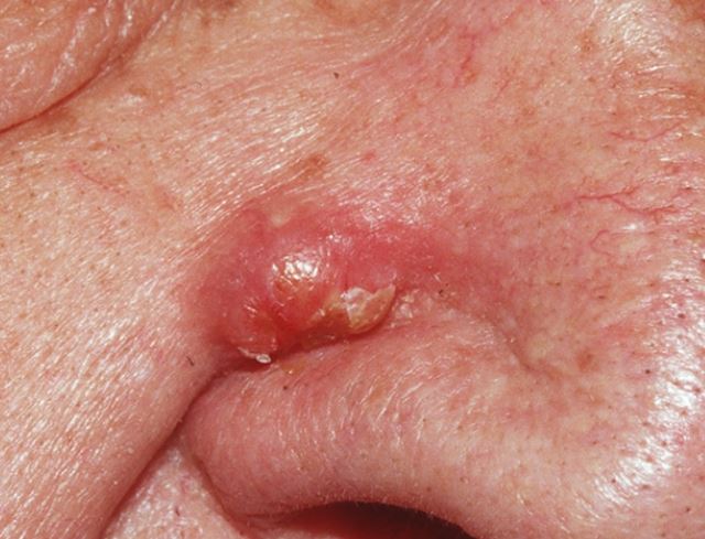 Cysts on nose - epidermoid cysts