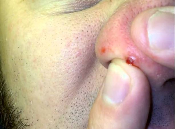 Ingrown nose hair
