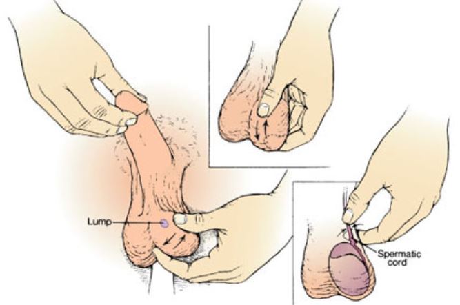lump on testicles