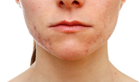 chin acne