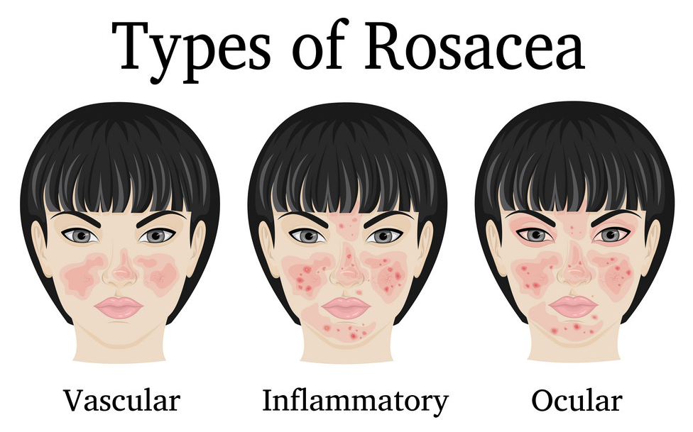 rosacea